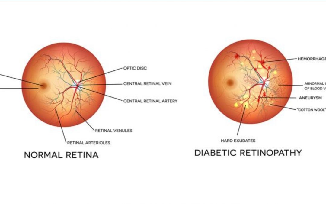 Steps towards gene therapy for diabetic retinopathy