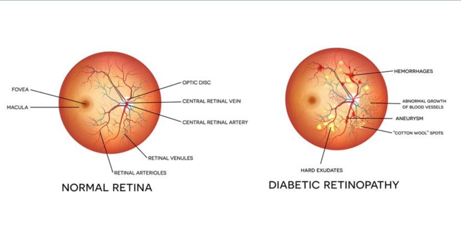 steps-towards-gene-therapy-for-diabetic-retinopathy-australian-vision