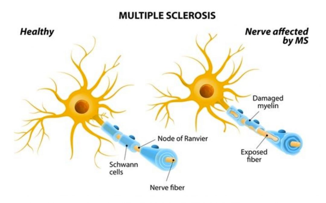 Gaining a better understanding of optic nerve damage in MS and neuromyolitis optica (NMO)