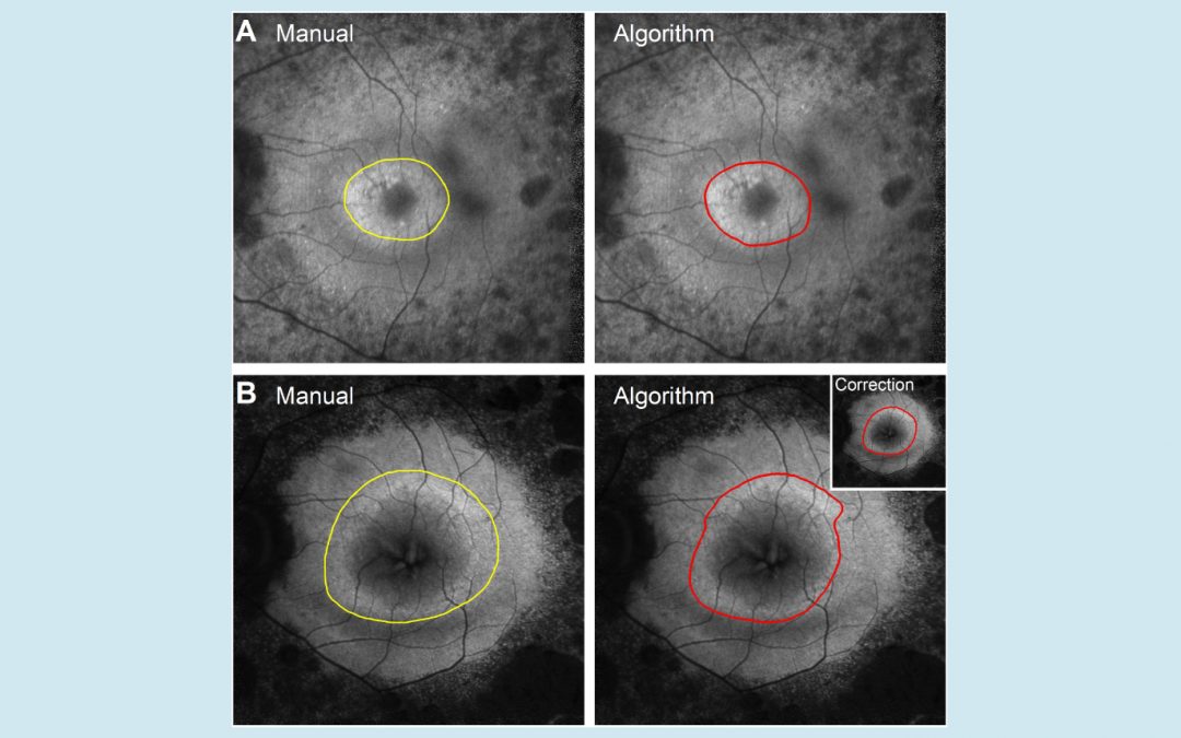 Applying machine learning to efficiently analyse fundus autofluorescence images in preparation for gene therapy 